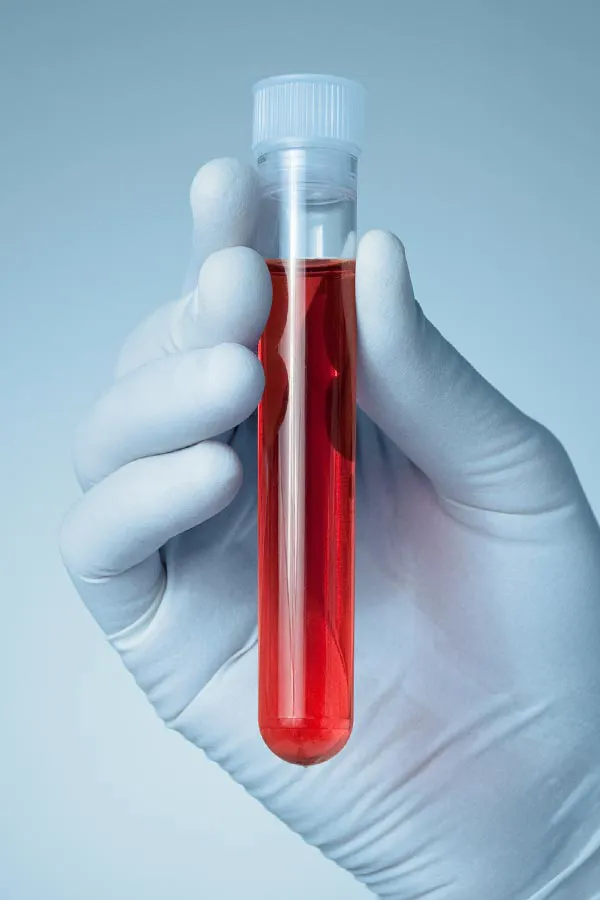 Autoimmune-Treatment A close-up of a doctor's gloved hand holding a vial a plasma, signifying autoimmune disease treatment from Regenerative Medical Institute in Greenville.