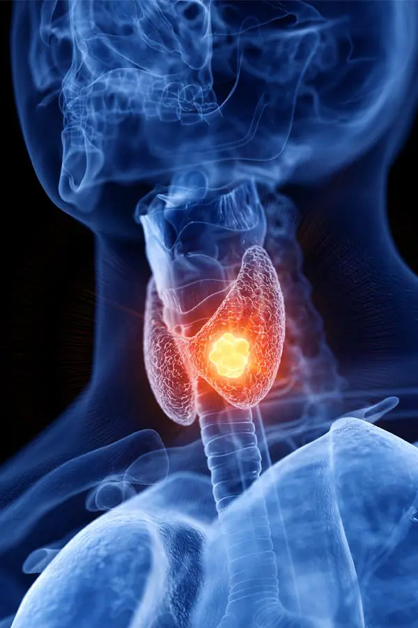 Thyroid-Imbalance-Treatment A 3D illustration of an x-ray of a human neck, highlighting the thyroid. Get help with thyroid imbalance from Regenerative Medical Institute in Greenville.