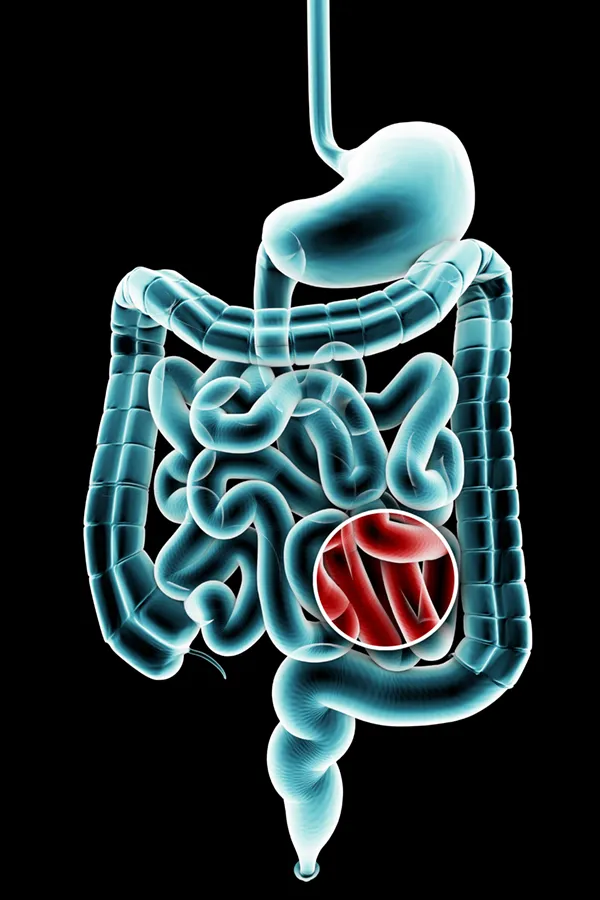 Ulcerative-Colitis-Treatment 3D illustration of the digestive system in blue tones, with an area of discomfort in red tones. Get treatment for Ulcerative Colitis from Regenerative Medical Institute in Greenville.