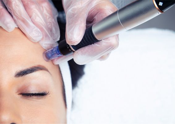 microneedlingmesotherapy-clinic Close up of a woman and microneedling pen during a Microneedling with Mesotherapy treatment in Greenville.